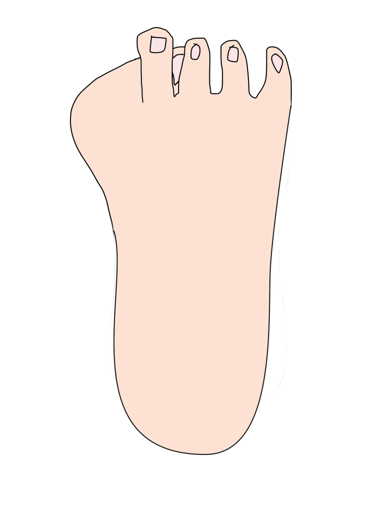 外反母趾の足